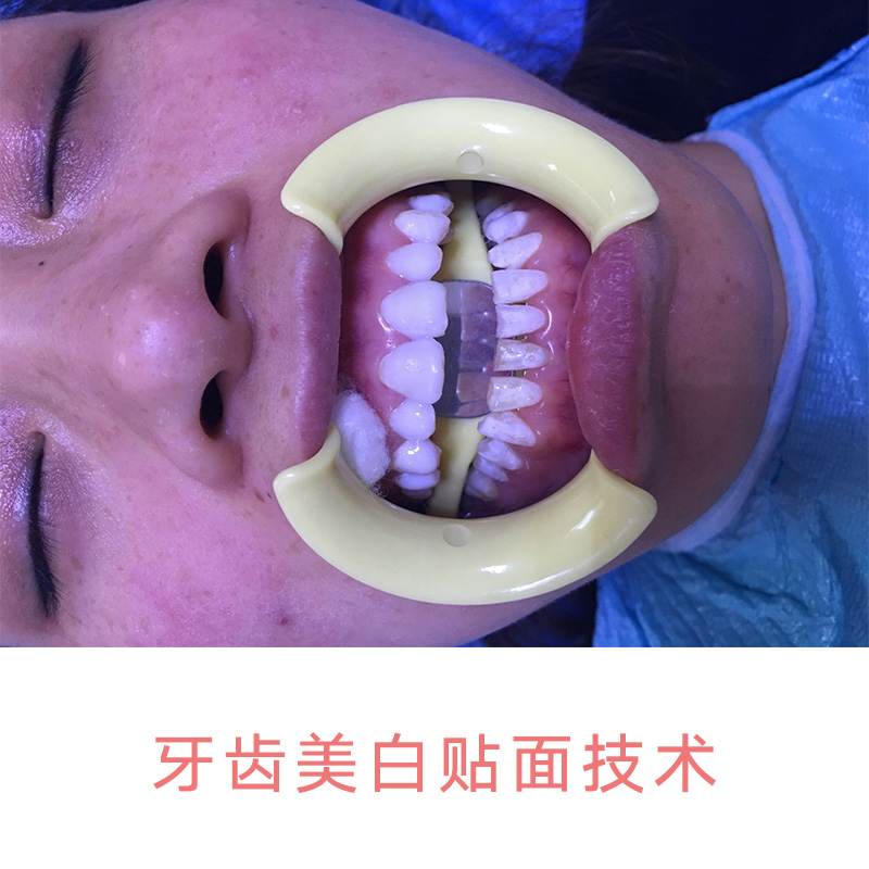 供应牙齿美白贴面技术 牙齿美白贴面技术培训 牙齿美白贴面技术公司
