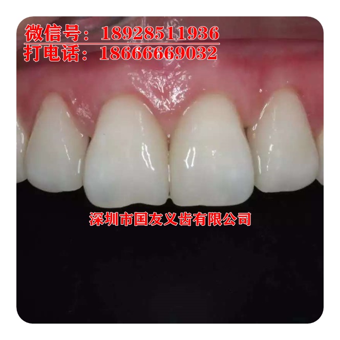 深圳厂家直销一颗全瓷牙的价格翡翠超薄全瓷贴面的优缺点及一颗的价格图片