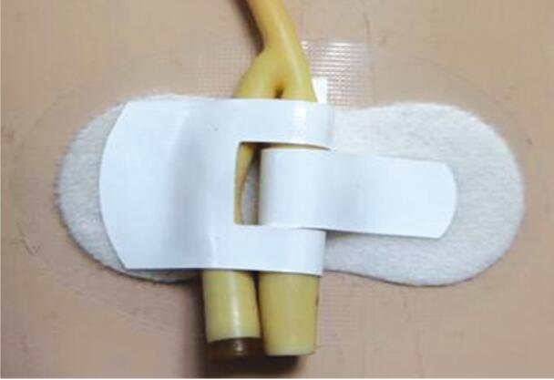 导尿管固定装置,体表导管固定装置