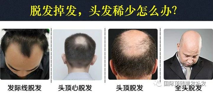 头发少怎么增发补发？国际顶臻医美增发补发适合哪种脱发？图片
